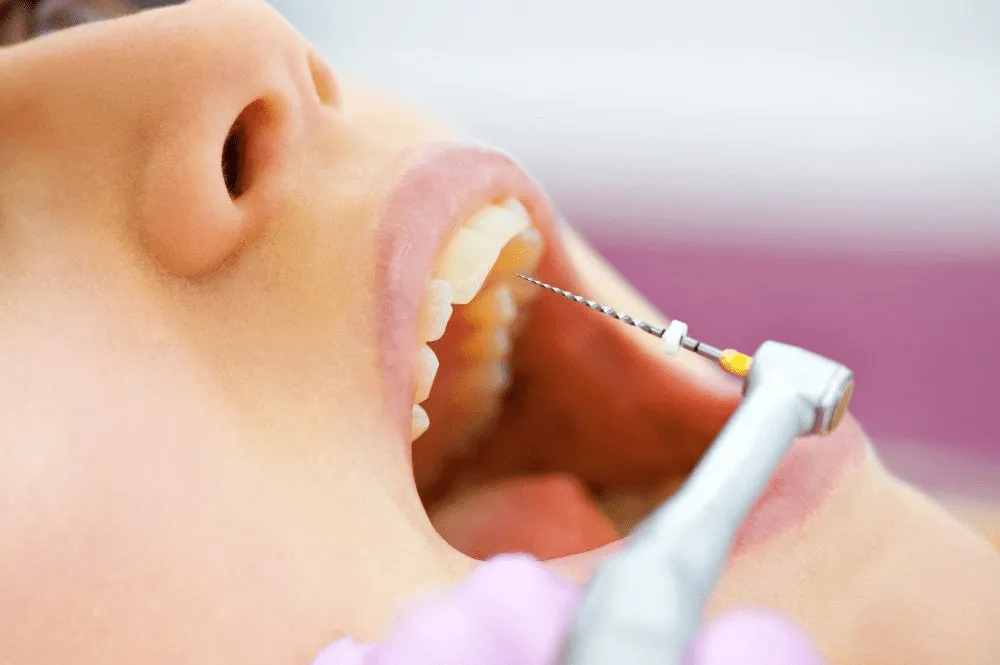 Dentist-for-Root-Canal-Treatment.webp