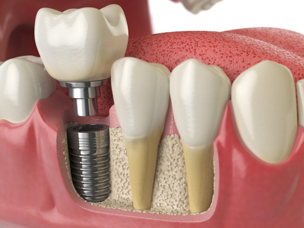 anatomy of healthy teeth and tooth dental implant in human dentu 1024x768 1