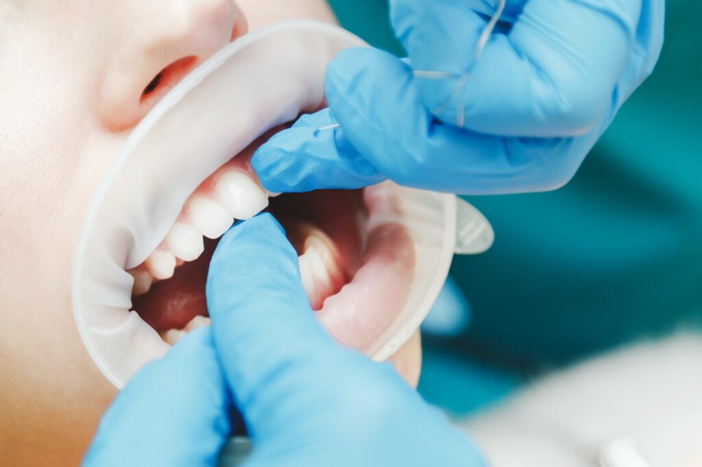 Full Mouth Reconstruction 1 close up of female mouth with retractor doctor flossing the teeth 1024x682 1
